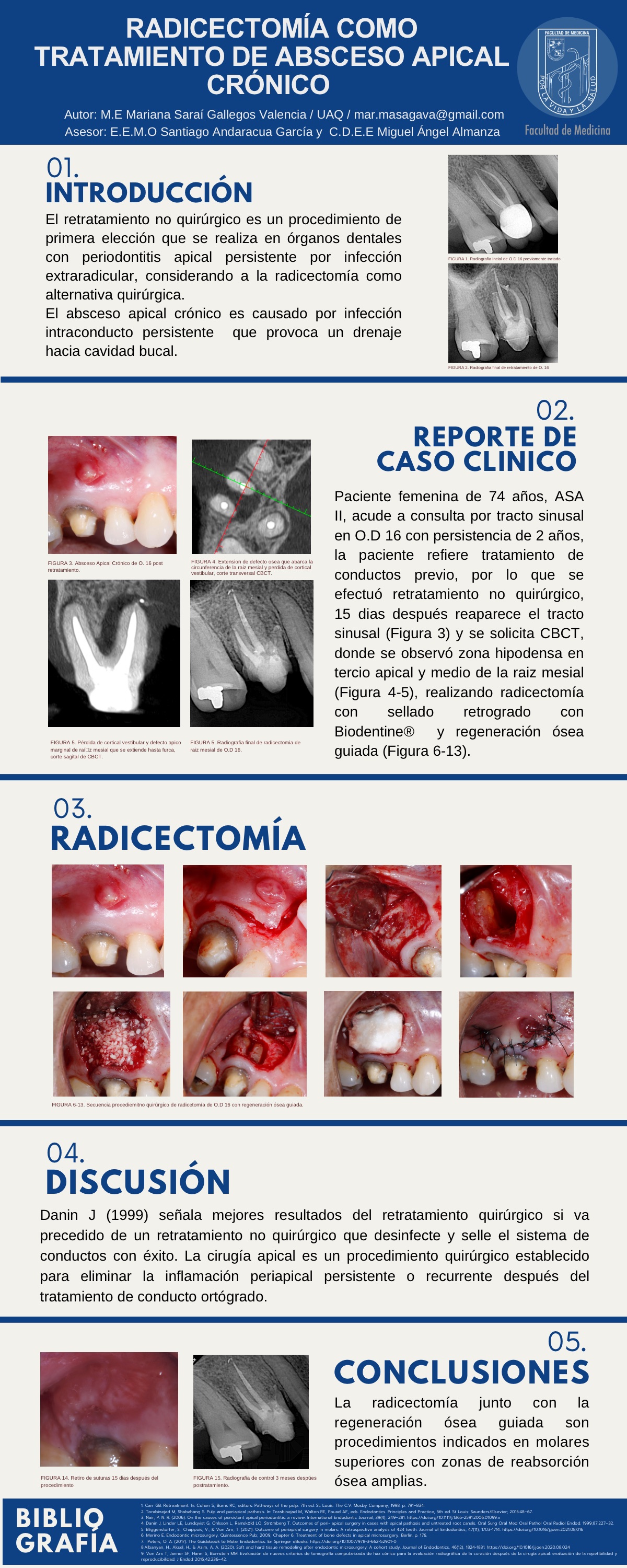 Cartel: RADICECTOMIA COMO TRATAMIENTO DE ABSCESO APICAL CRÓNICO