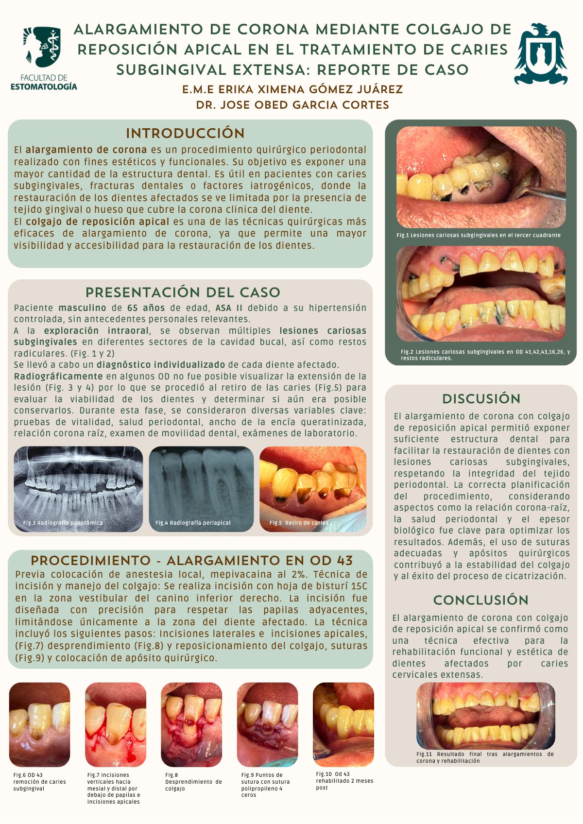 Cartel: ALARGAMIENTO DE CORONA MEDIANTE REPOSICIÓN APICAL EN EL TRATAMIENTO DE CARIES SUBGINGIVAL EXTENSA: REPORTE DE CASO