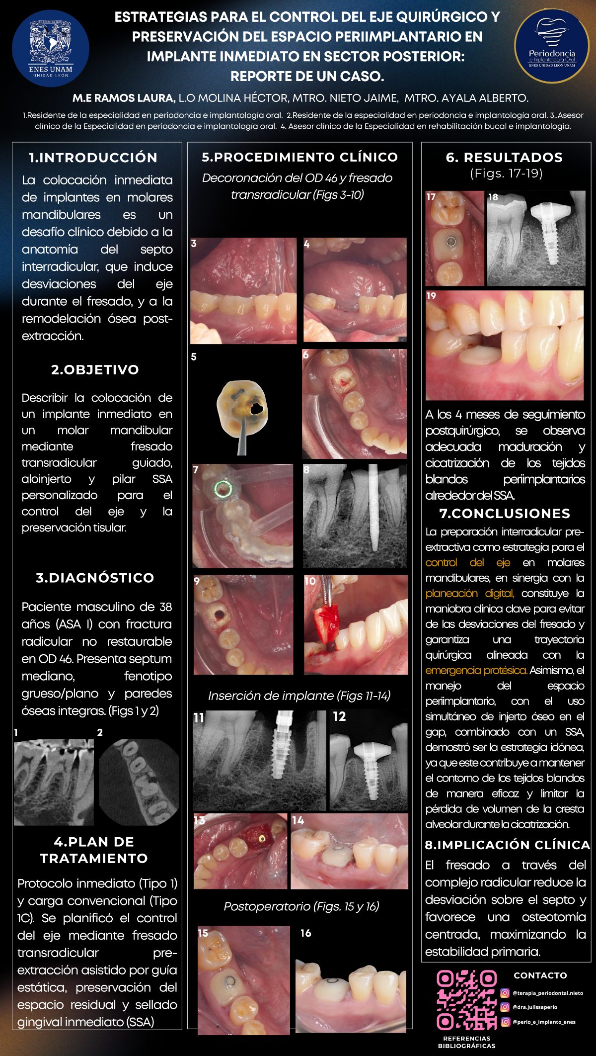 Cartel: Estrategias para el control del eje quirúrgico y preservación del espacio periimplantario en implante inmediato en sector posterior: Reporte de un caso.